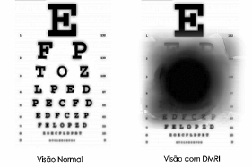 Degenerescência Macular Relacionada com a Idade